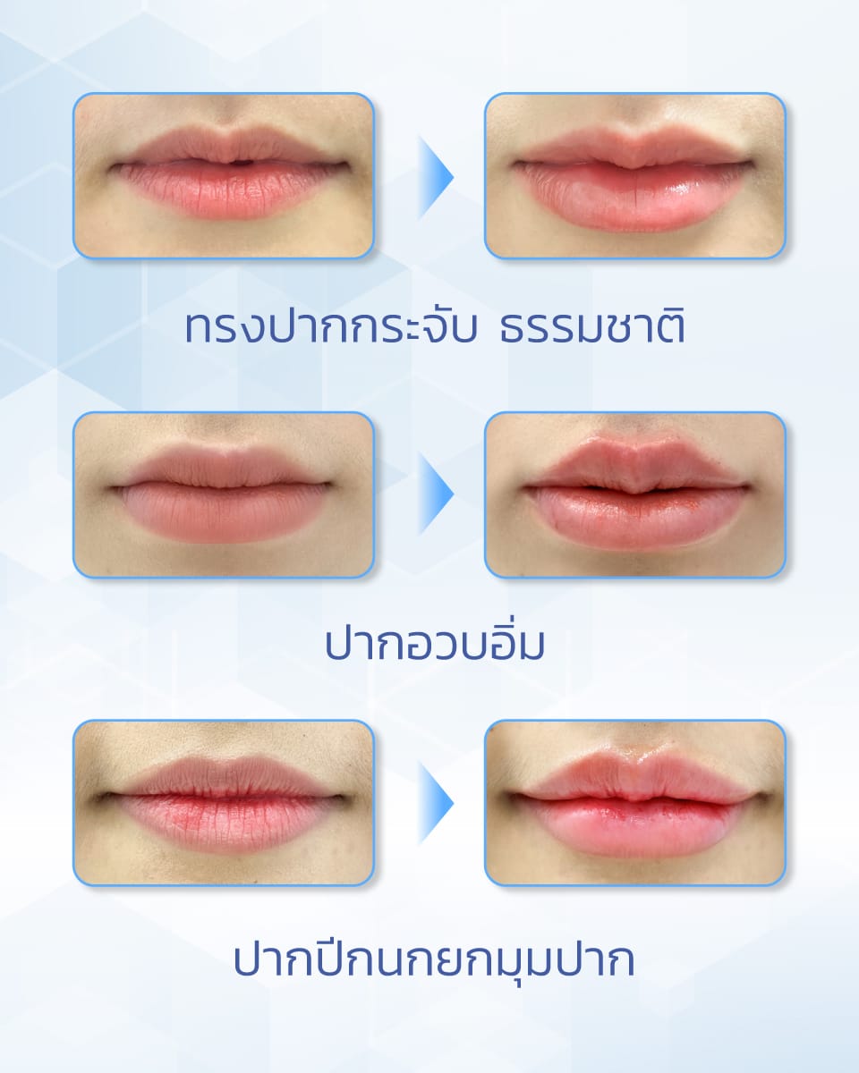 รูปทรงปากยอดนิยม