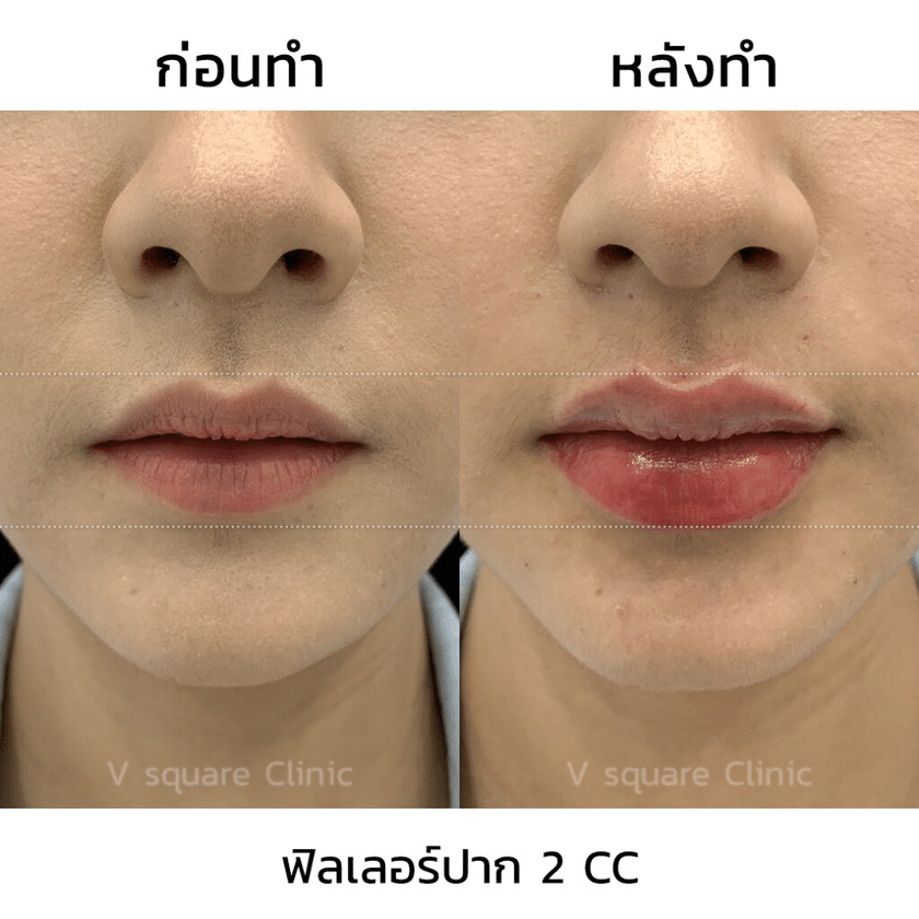 รีวิวฟิลเลอร์ปาก