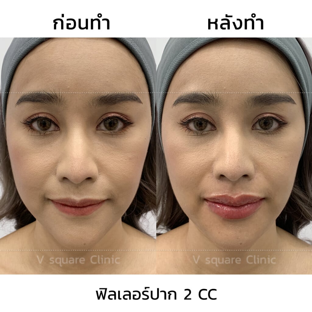 รีวิวฉีดฟิลเลอร์ปาก 2 CC