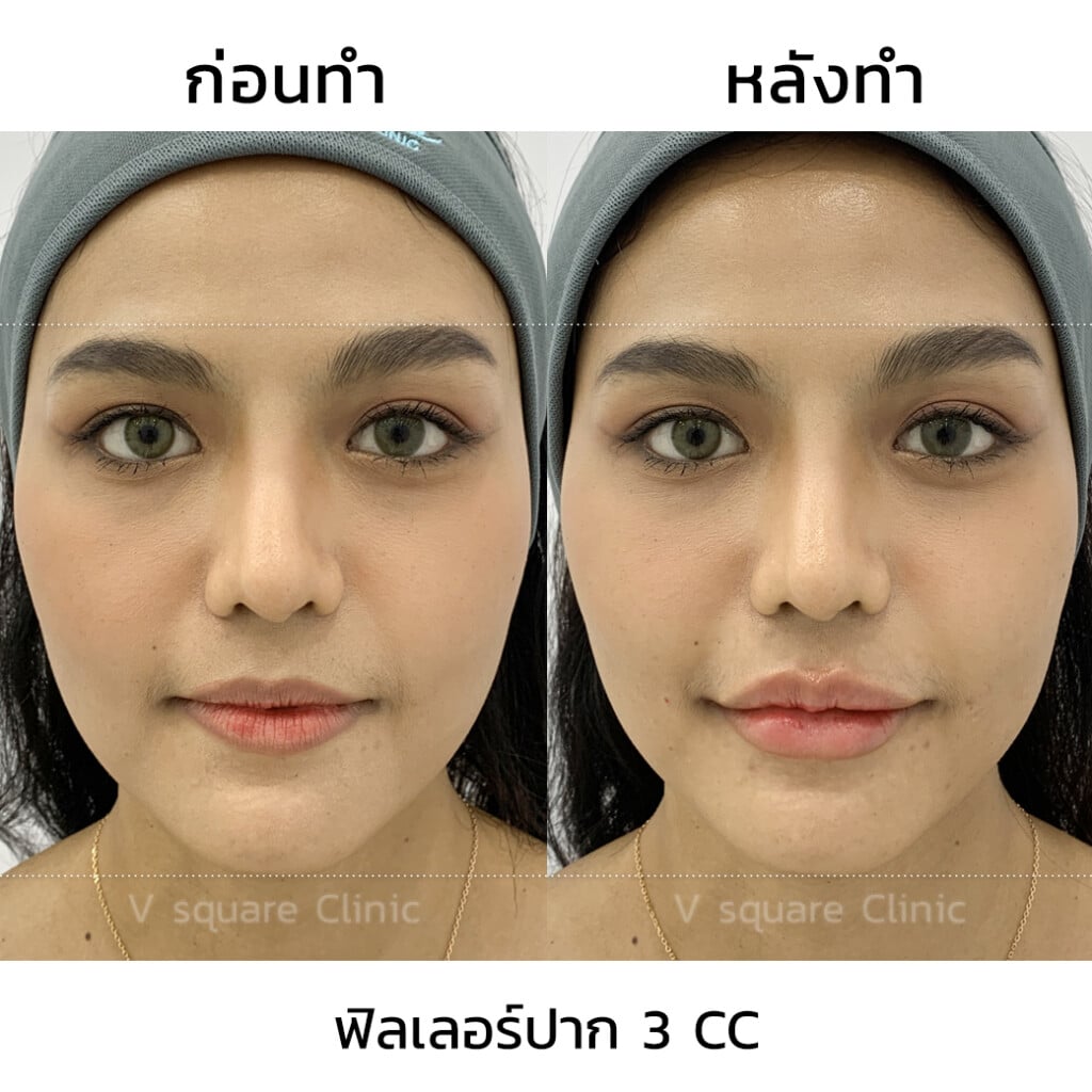 รีวิวฉีดฟิลเลอร์ปาก 3 CC