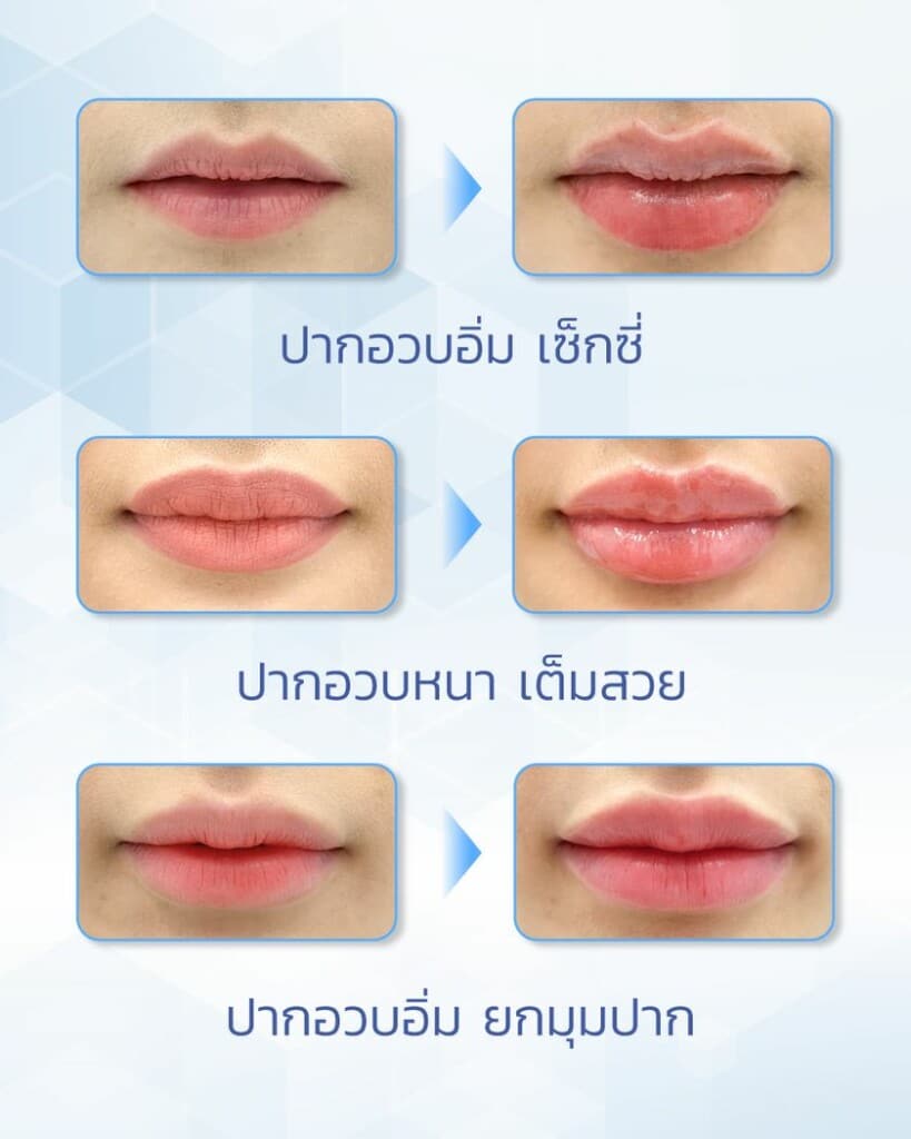 รีวิวฉีดฟิลเลอร์ปาก