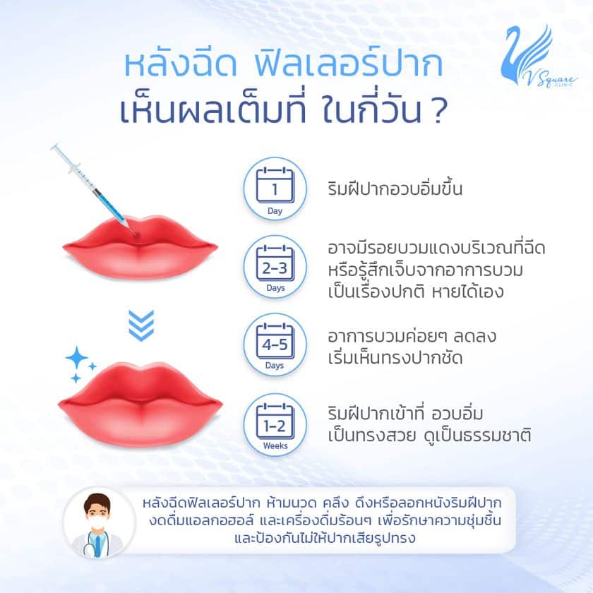 รีวิวฉีดฟิลเลอร์ปาก กี่วันเห็นผล