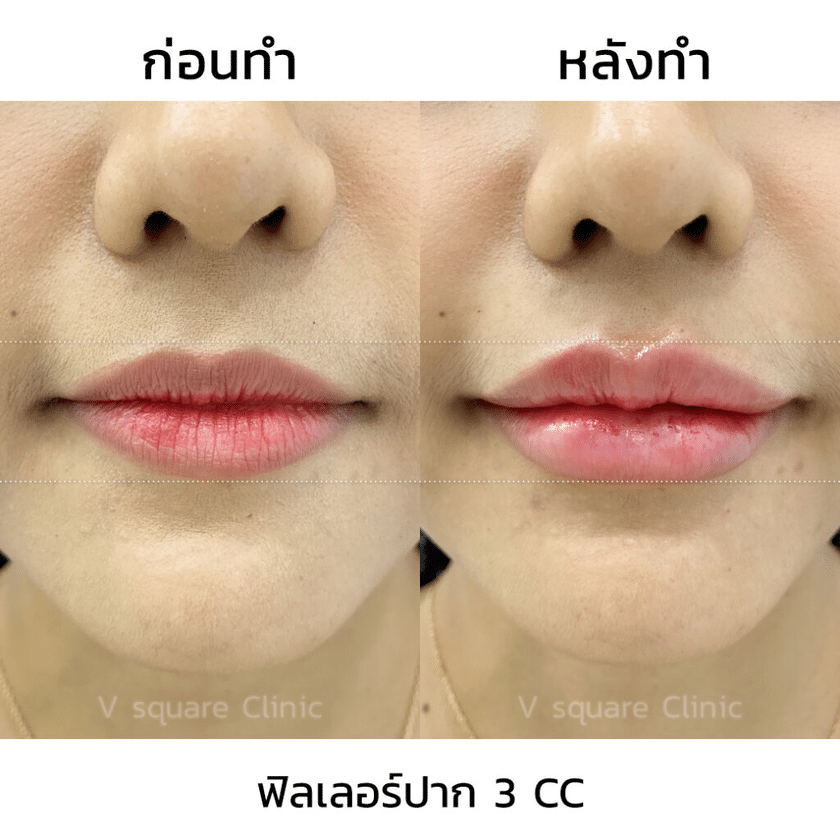 รีวิวฉีดฟิลเลอร์ปาก