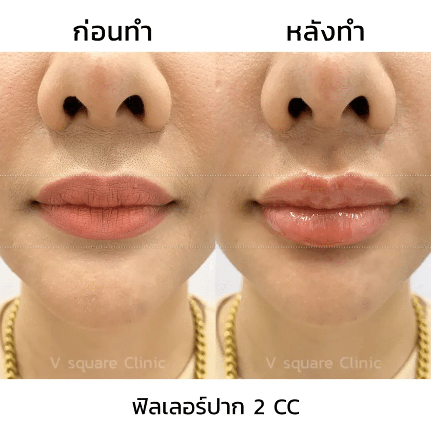 รีวิวฉีดฟิลเลอร์ปาก