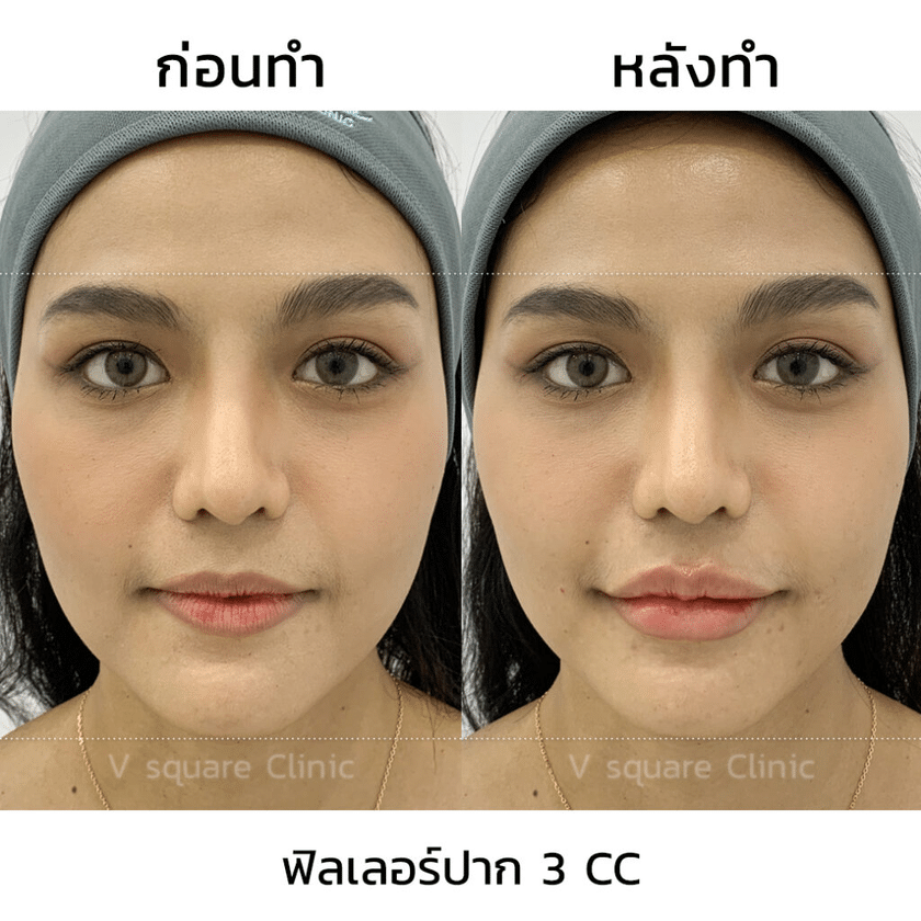 รีวิวฉีดฟิลเลอร์ปาก