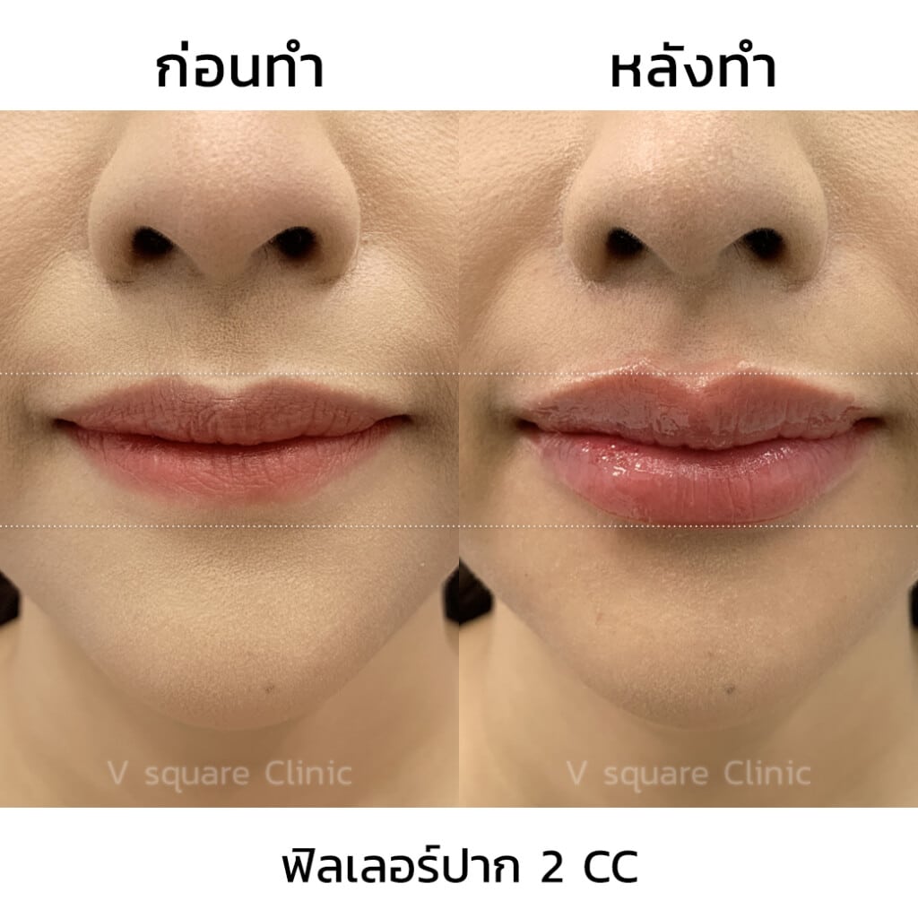 รีวิวฟิลเลอร์ปาก 2 CC