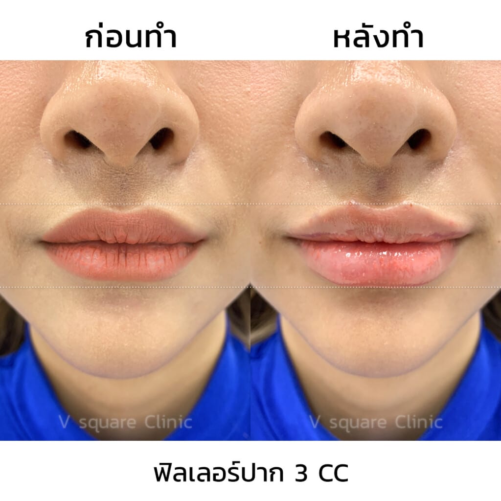 รีวิวฟิลเลอร์ปาก 3 CC