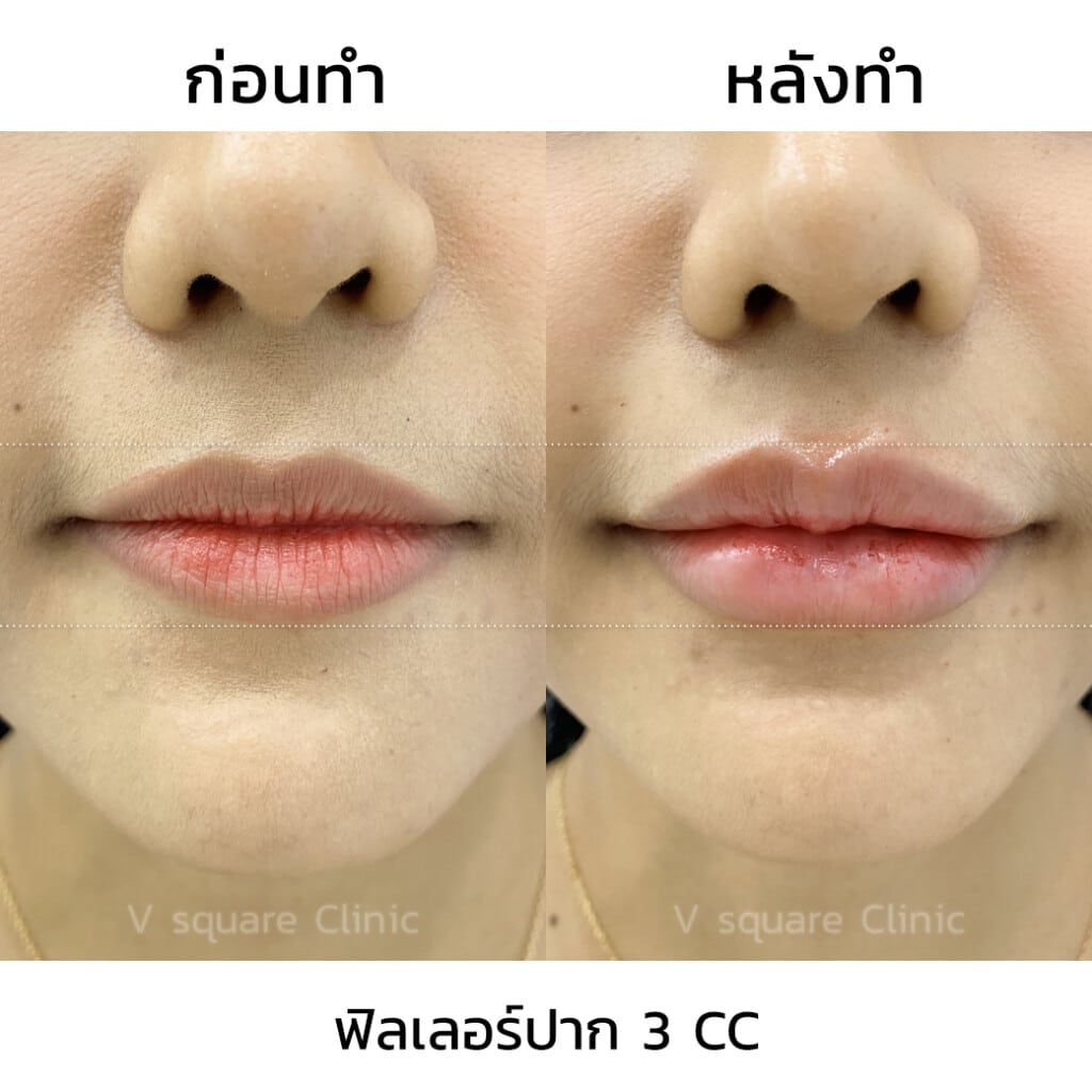 รีวิวฟิลเลอร์ปาก 3 CC