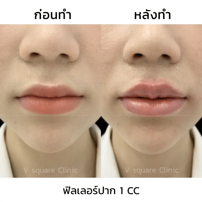 รีวิวฟิลเลอร์ปาก