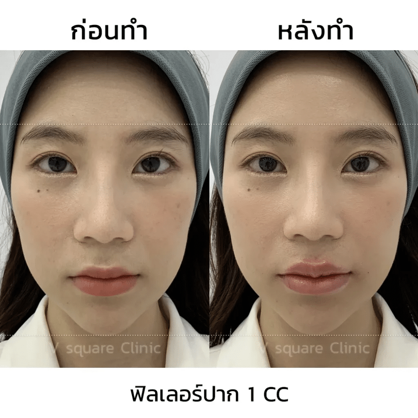 รีวิวฟิลเลอร์ปาก