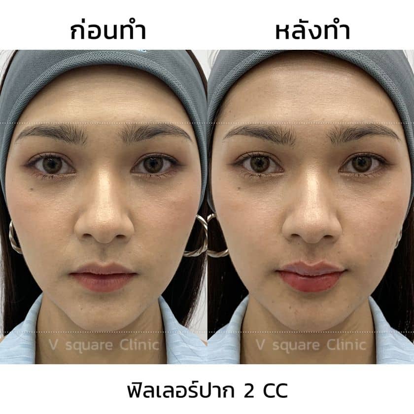 รีวิวผลลัพธ์ หลังฉีดฟิลเลอร์ปาก เคสจริง จาก V Square Clinic