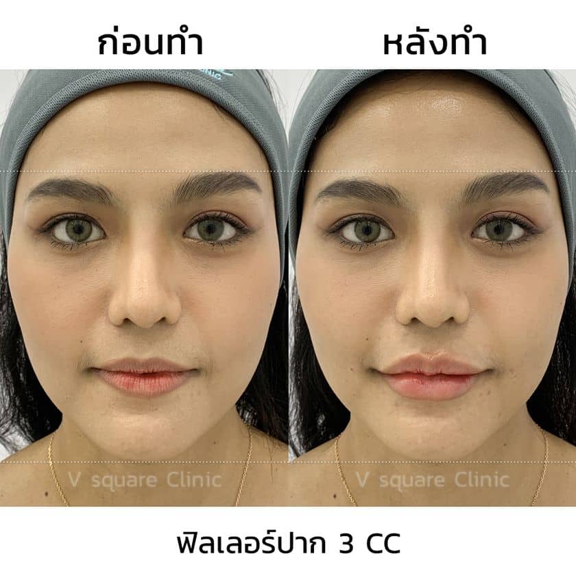 รีวิวผลลัพธ์ หลังฉีดฟิลเลอร์ปาก เคสจริง จาก V Square Clinic