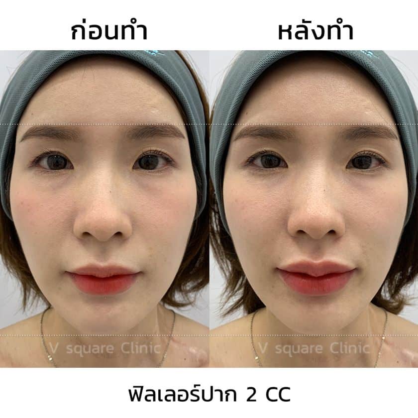 รีวิวผลลัพธ์ หลังฉีดฟิลเลอร์ปาก เคสจริง จาก V Square Clinic