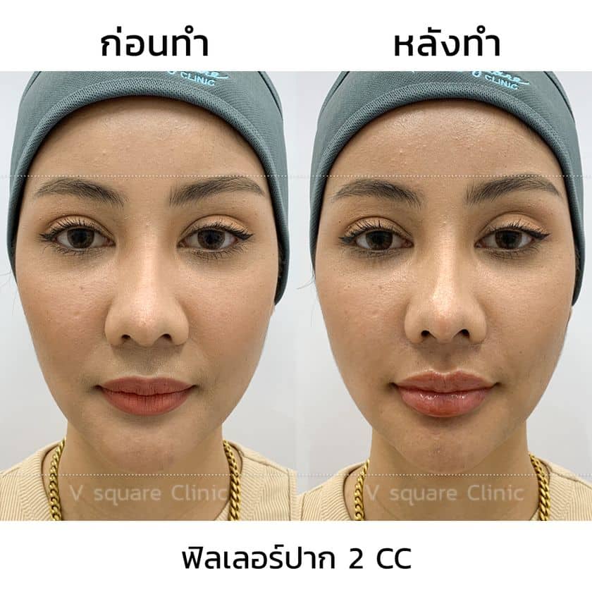 รีวิวผลลัพธ์ หลังฉีดฟิลเลอร์ปาก เคสจริง จาก V Square Clinic