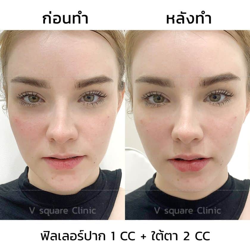 รีวิวผลลัพธ์ หลังฉีดฟิลเลอร์ปาก เคสจริง จาก V Square Clinic โดย คุณเจสซี่