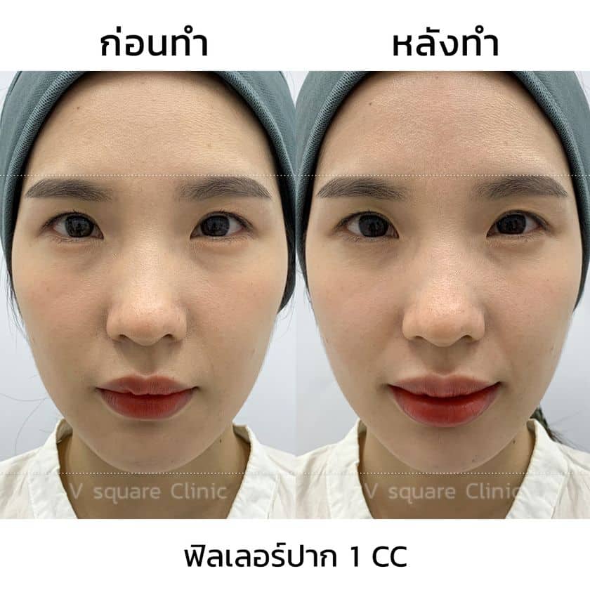 รีวิวผลลัพธ์ หลังฉีดฟิลเลอร์ปาก เคสจริง จาก V Square Clinic