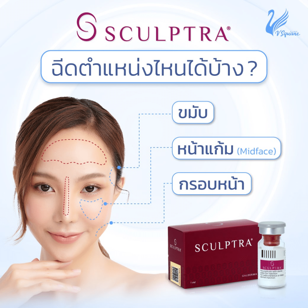 ตำแหน่งฉีด Sculptra