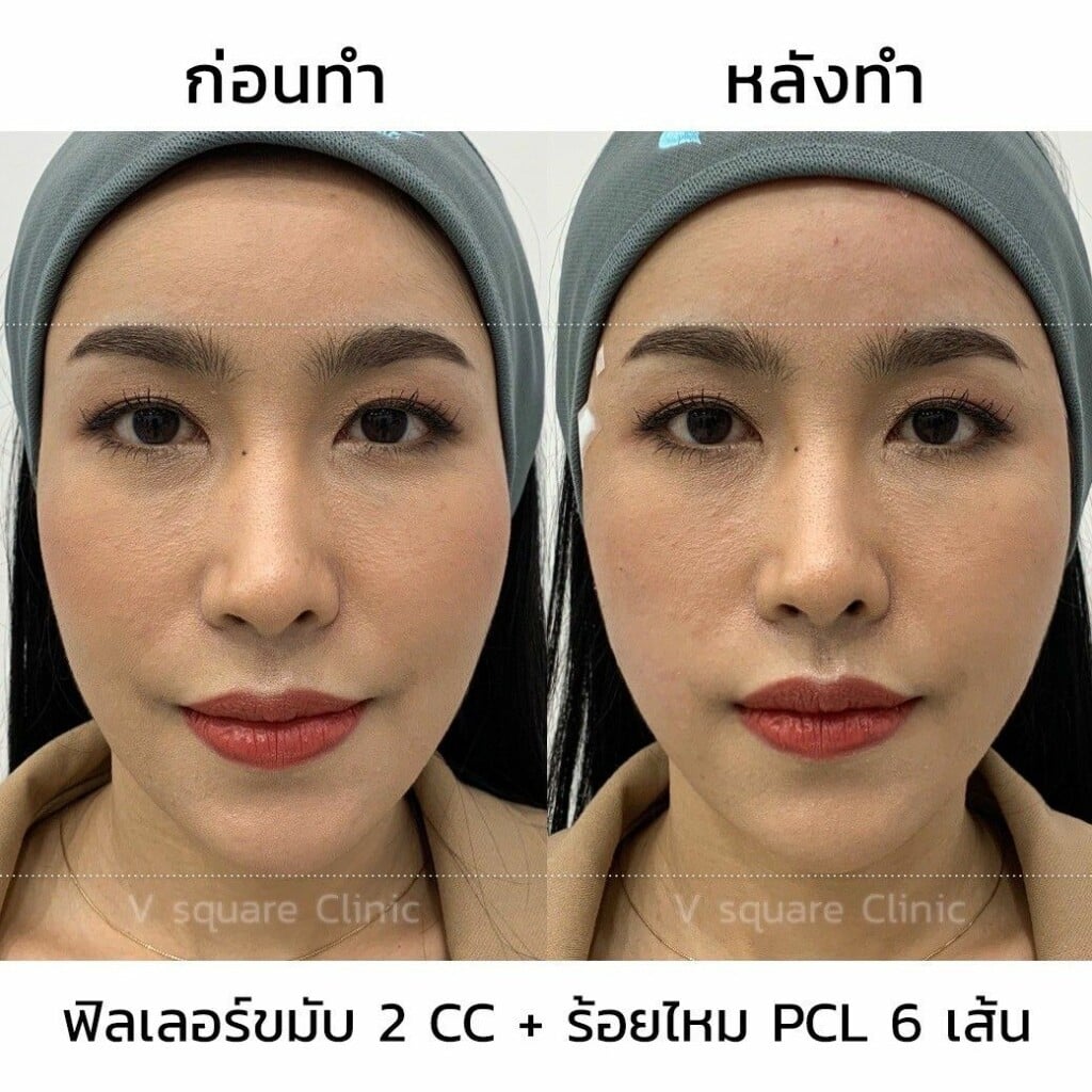 รีวิวฉีดฟิลเลอร์ขมับ 2 CC