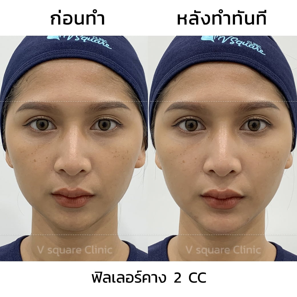 รีวิวฉีดฟิลเลอร์คาง