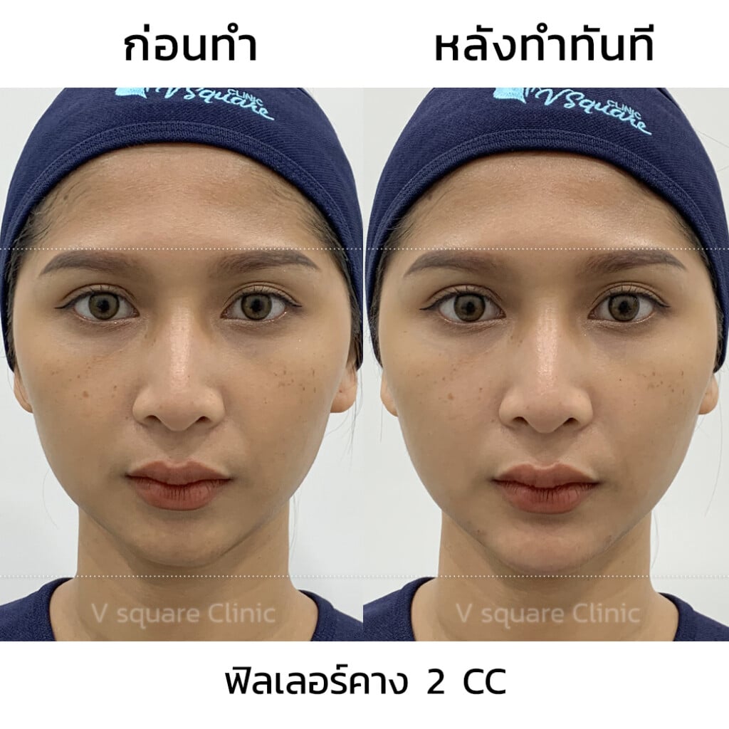 รีวิวฟิลเลอร์คาง