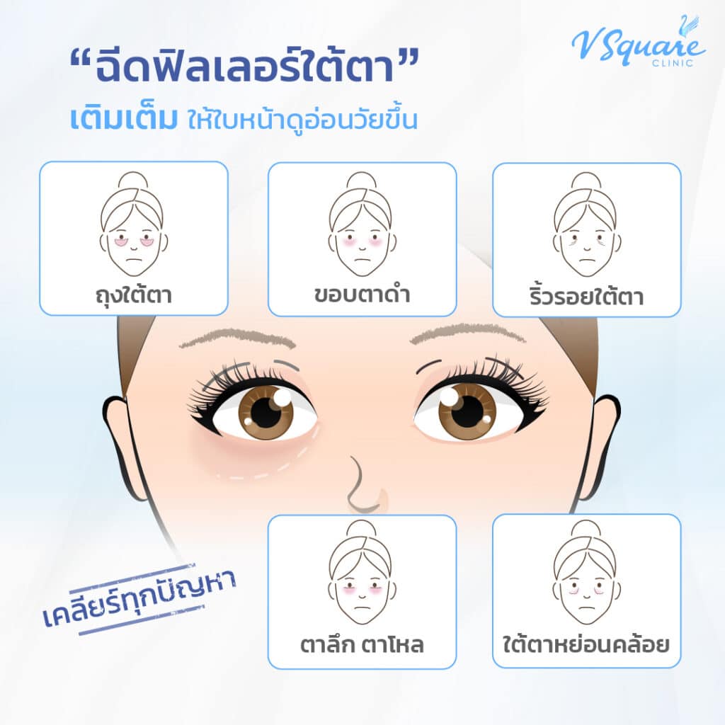 ฉีดฟิลเลอร์ใต้ตา