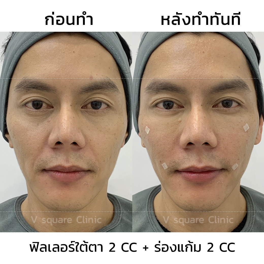 รีวิวฟิลเลอร์ใต้ตา ผู้ชาย