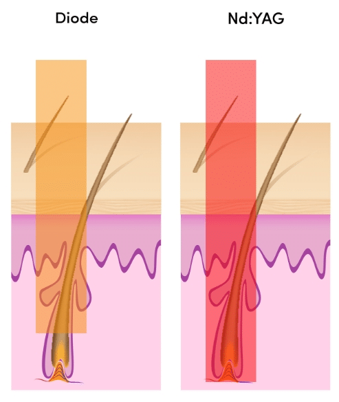 diode laser vs yag