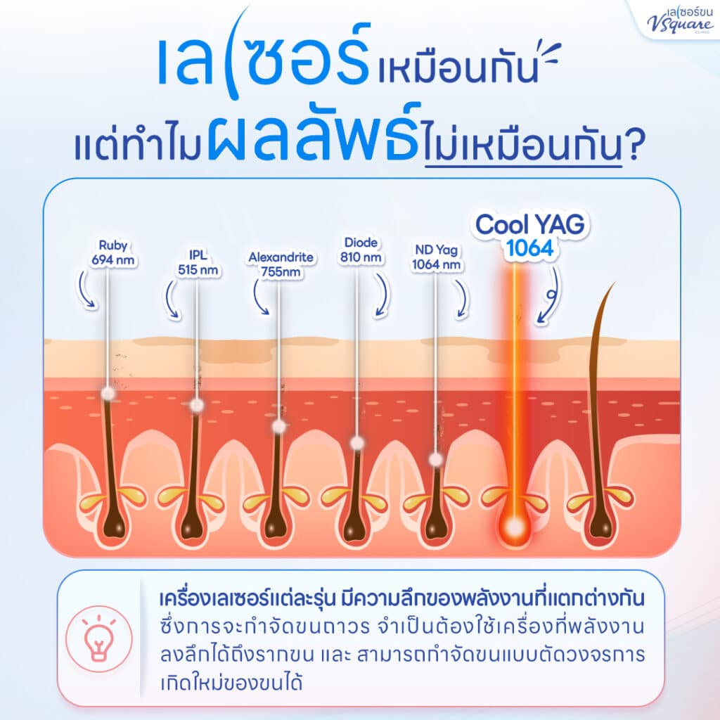 ชนิดของเลเซอร์ สาเหตุที่เลเซอร์ขนจิมิราคาไม่เท่ากัน