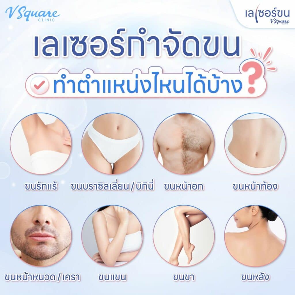 ตำแหน่งเลเซอร์ขน