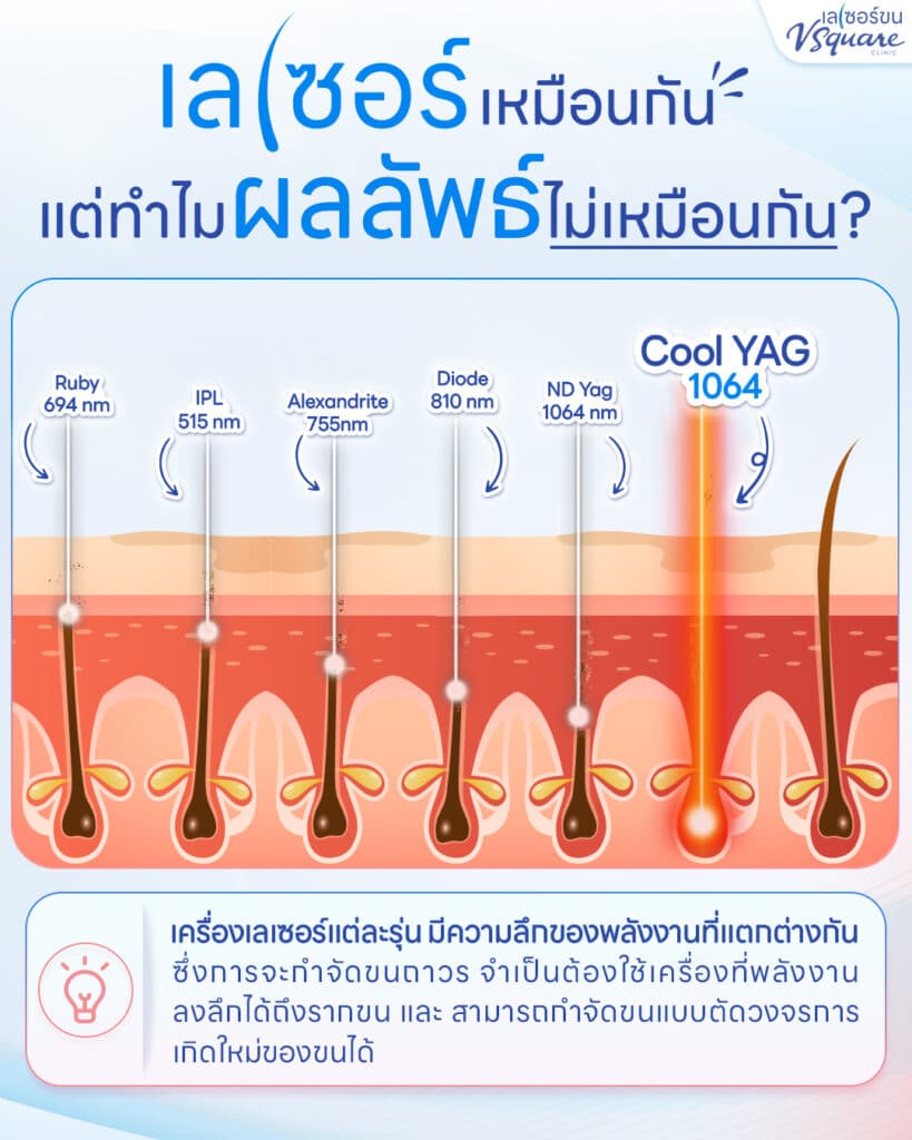 เครื่องเลเซอร์แต่ละยี่ห้อ