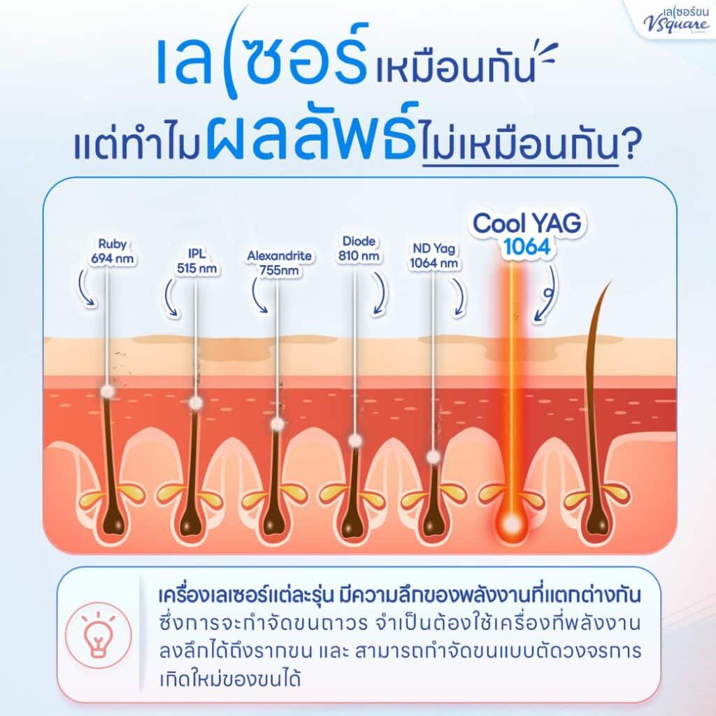 เลเซอร์กำจัดขน