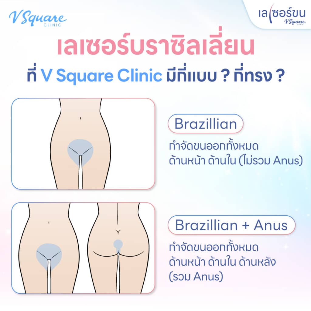 เลเซอร์บราซิลเลี่ยน ราคาแตกต่างกันตามพื้นที่ที่ทำ