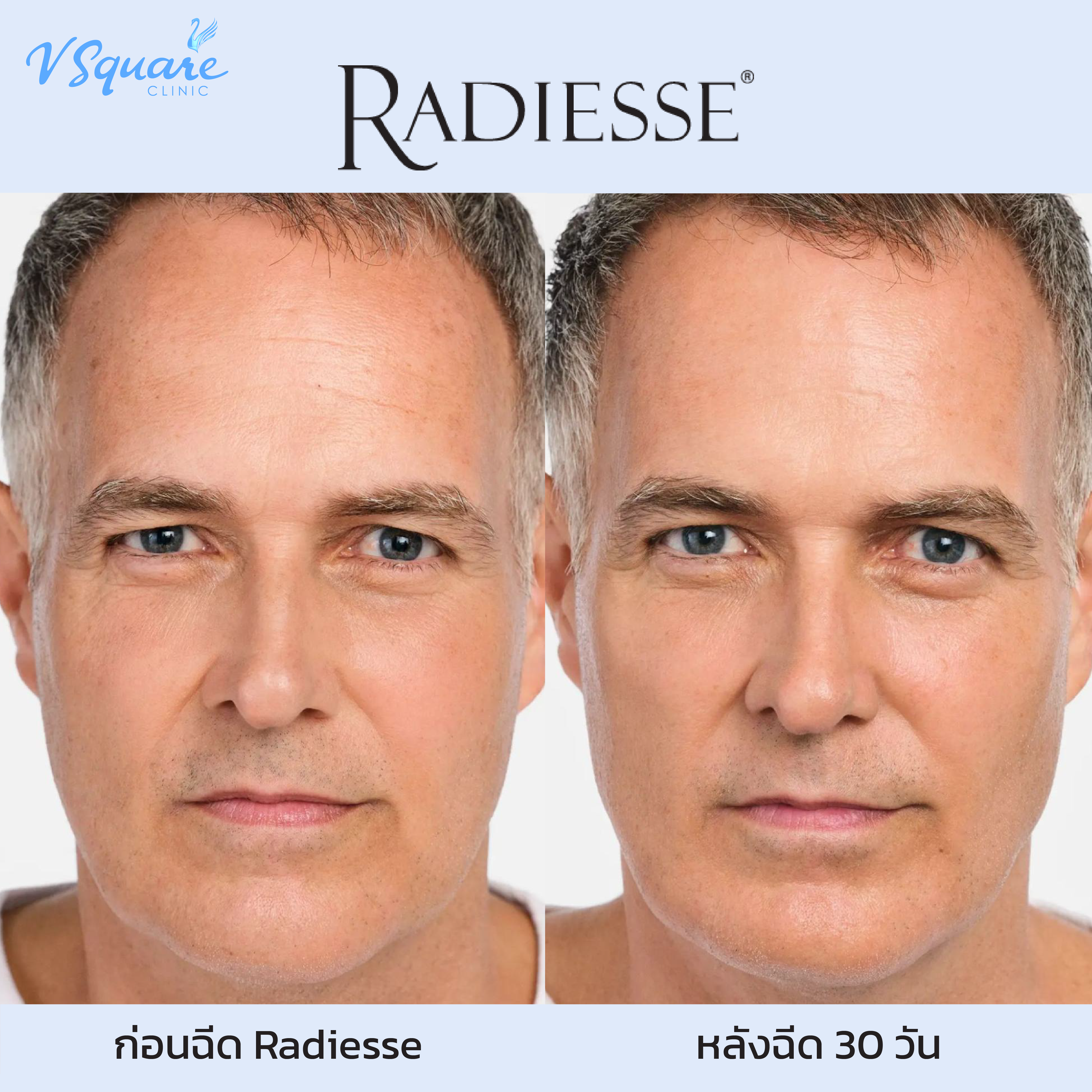 รีวิว radiesse 