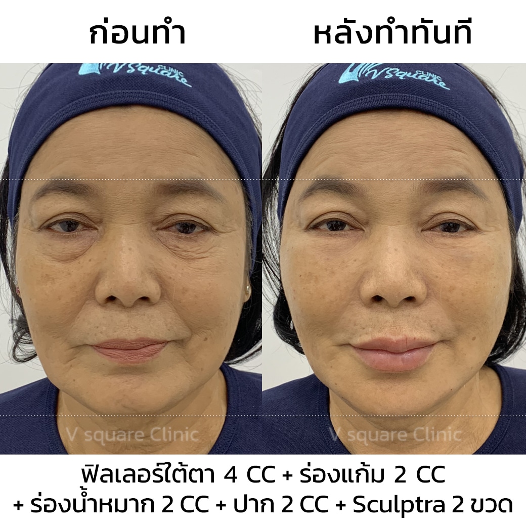 รีวิว sculptra