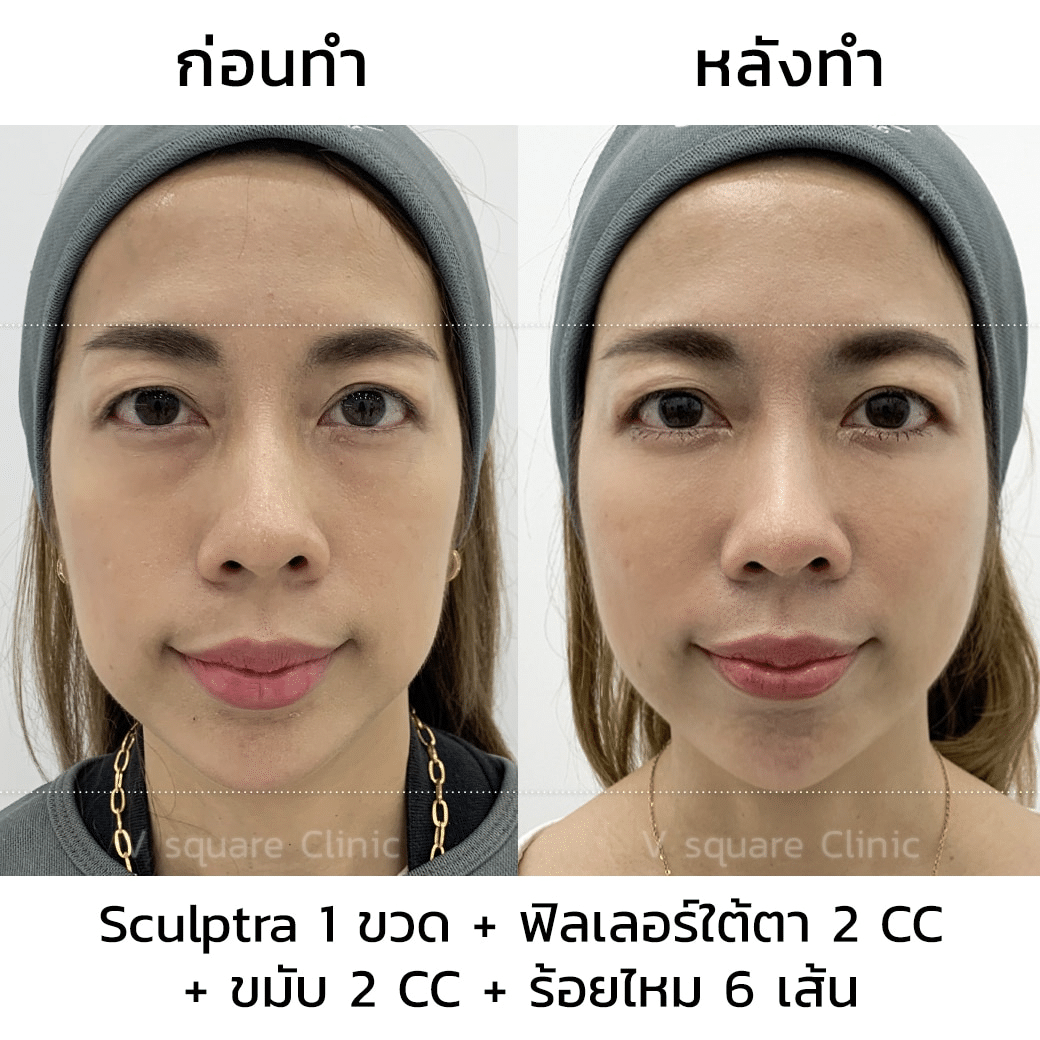 รีวิว sculptra