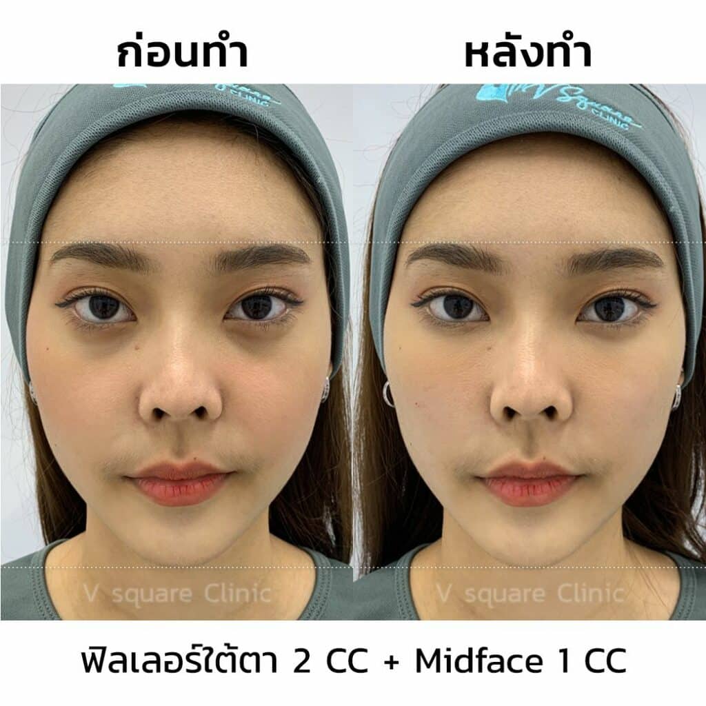 รีวิวฉีดฟิลเลอร์ใต้ตา