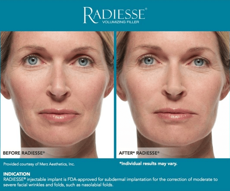 Radiesse รีวิว