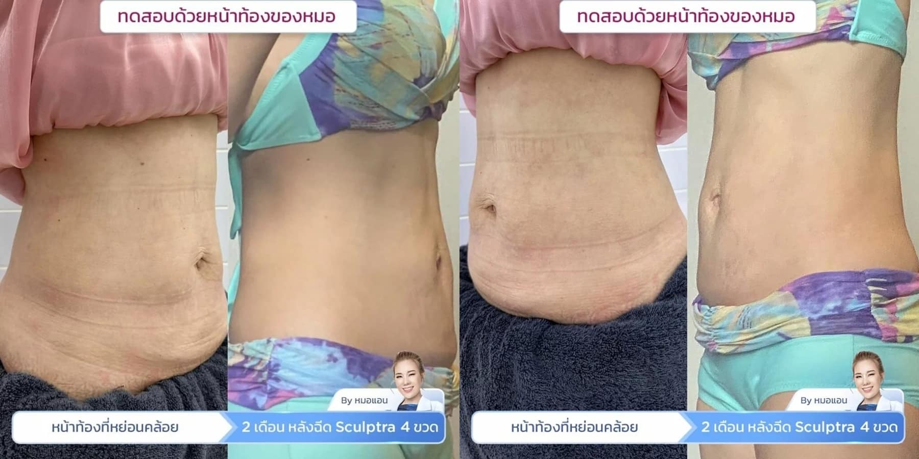 รีวิว Sculptra Body