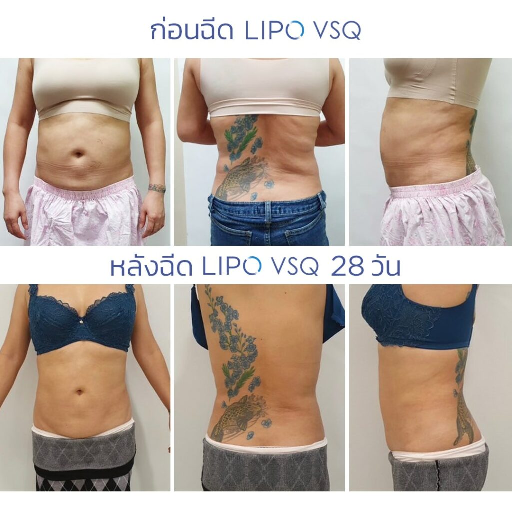 รีวิวเมโสแฟต Lipo VSQ