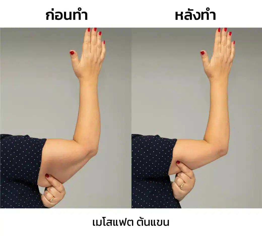 เมโสแฟตแขนรีวิว