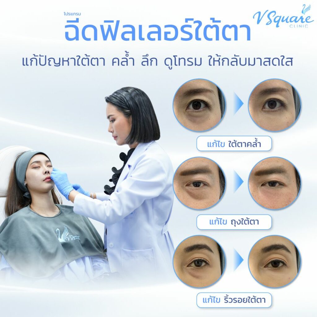 ฉีดฟิลเลอร์ใต้ตาที่ V Square Clinic 