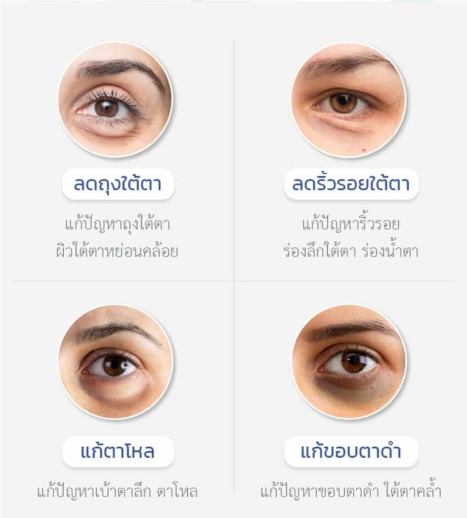 ฉีดไขมันใต้ตา ช่วยแก้ปัญหาอะไร