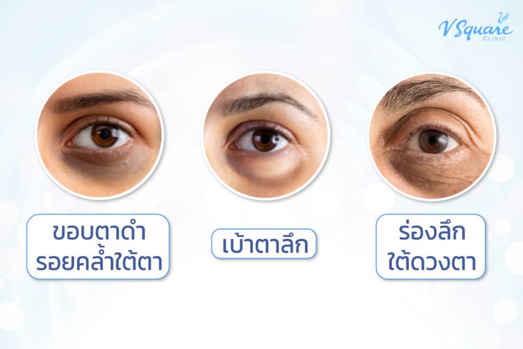 ปัญหาใต้ตา