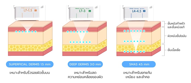 ระดับความลึกหัวยิง ulthera