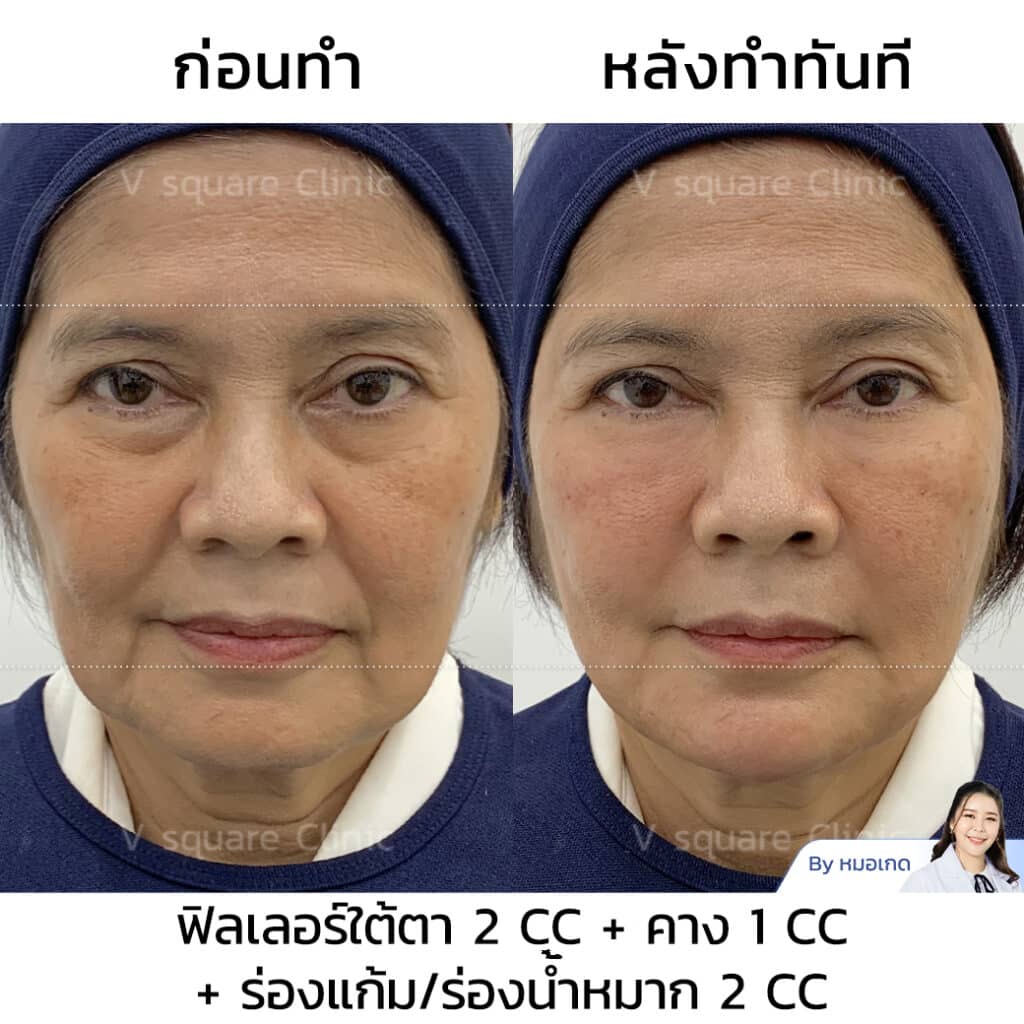 รีวิว ฉีดฟิลเลอร์ร่องแก้ม