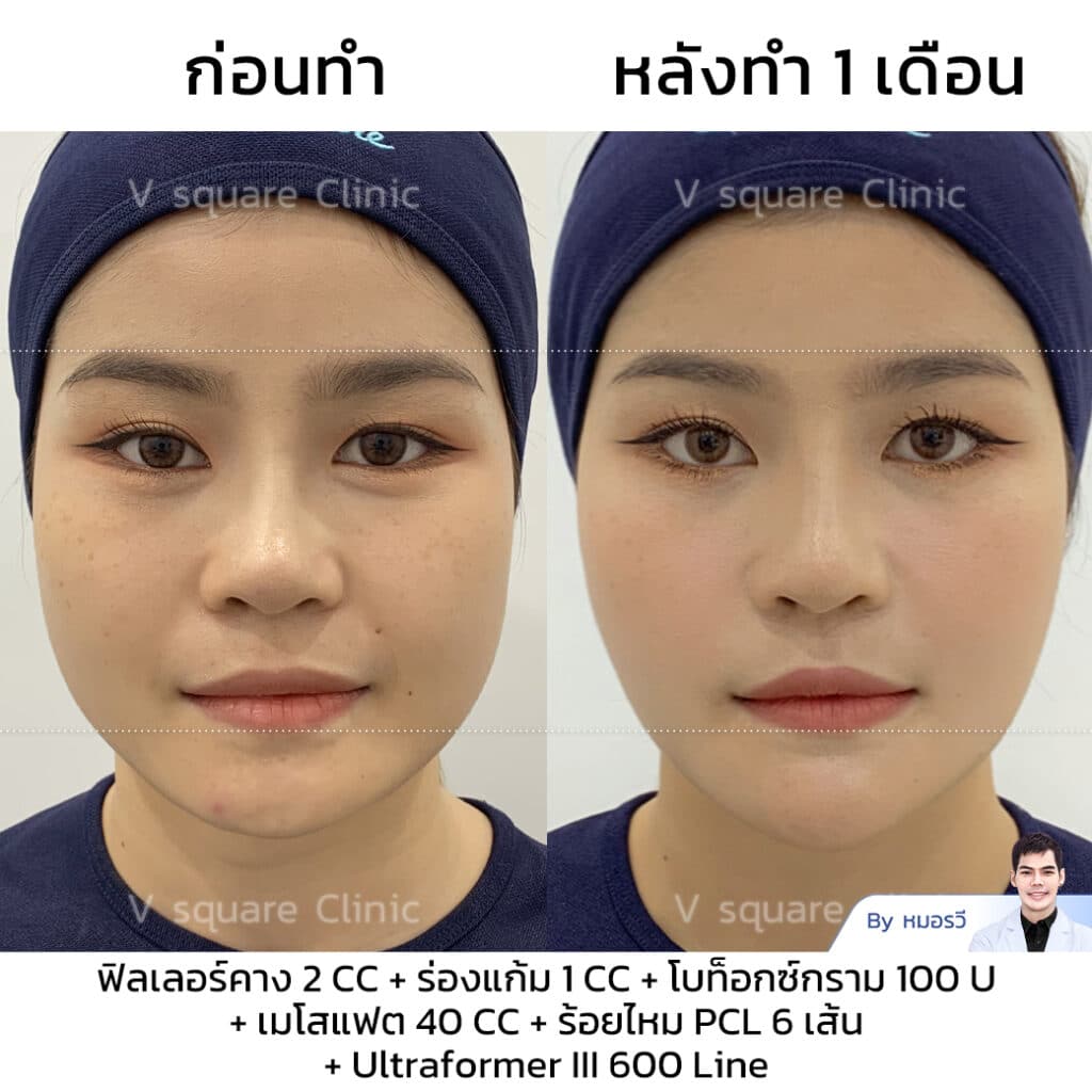 รีวิว ฉีดฟิลเลอร์ร่องแก้ม