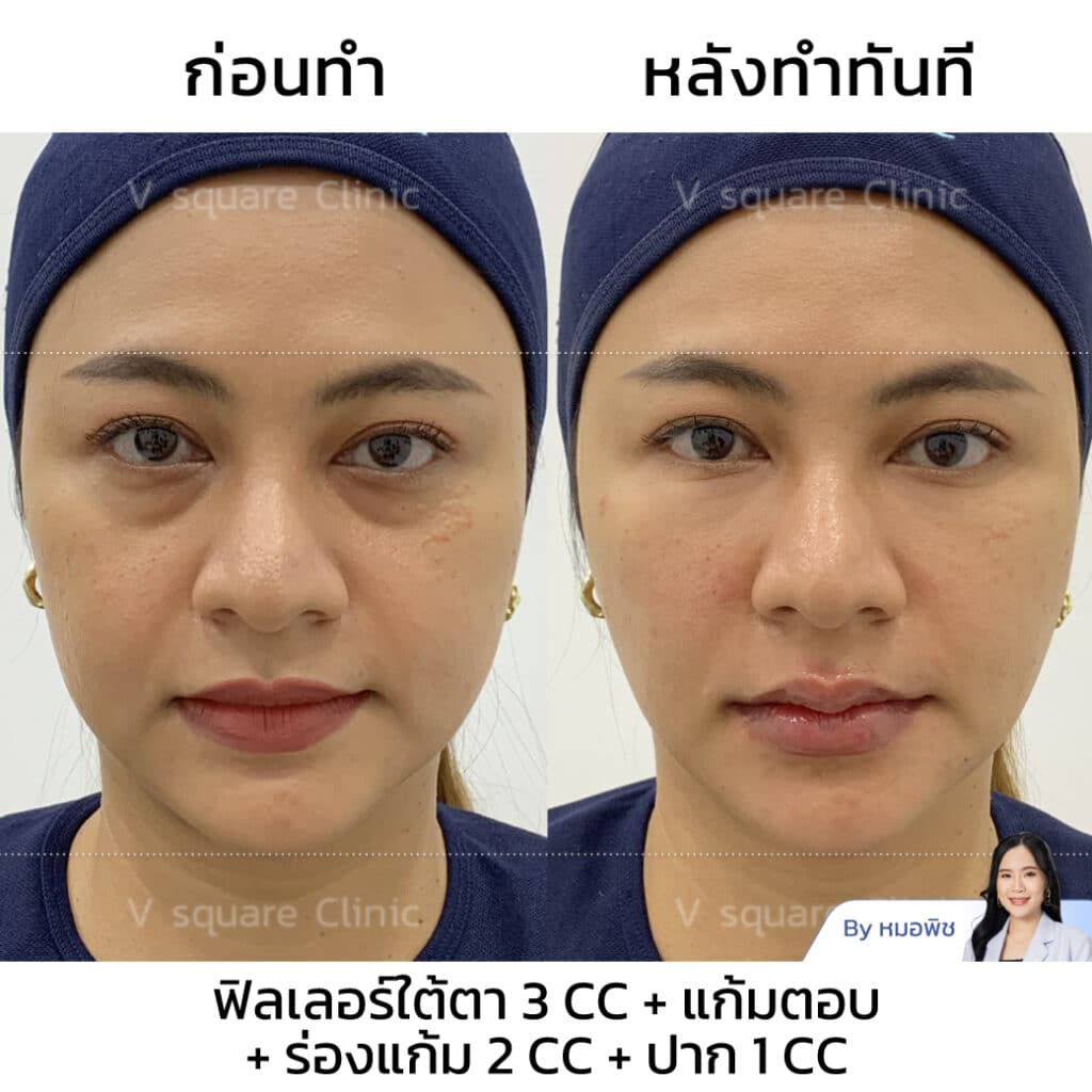 รีวิว ฉีดฟิลเลอร์ร่องแก้ม