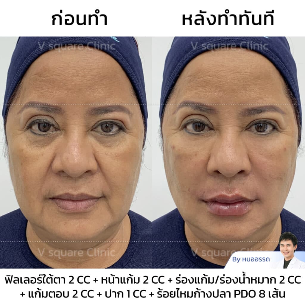 รีวิว ฉีดฟิลเลอร์ร่องแก้ม