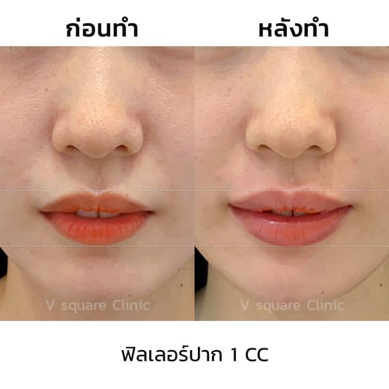 รีวิวฉีดฟิลเลอร์ปาก