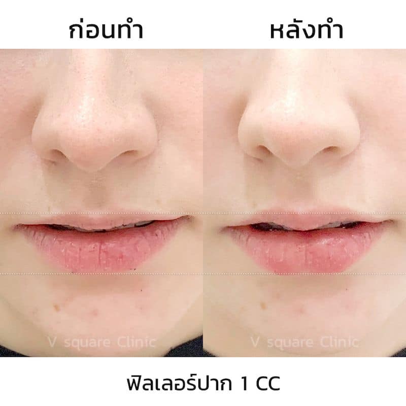 รีวิวฉีดฟิลเลอร์ปาก